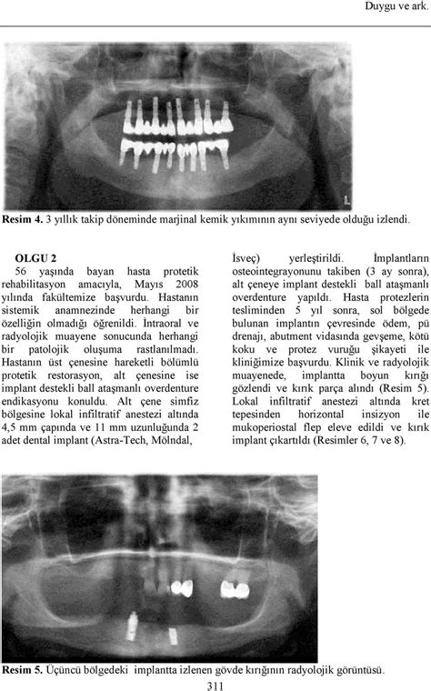 Mplant Destekli Sabit Ve Hareketli Protezlerde Implant K R