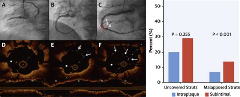 Subintimal Versus Intraplaque Recanalization Of Coronary Chronic Total