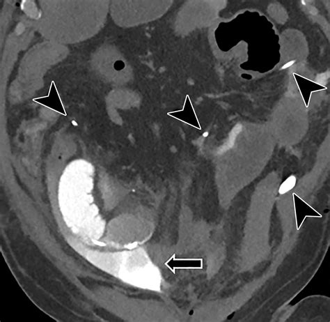 Complications Of Ileal Conduits After Radical Cystectomy