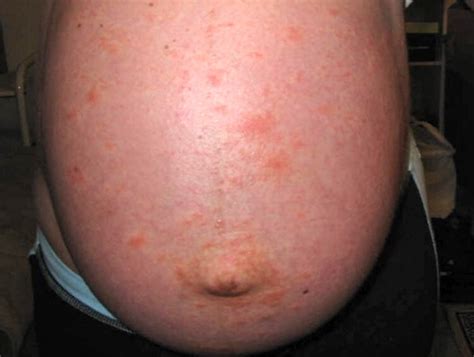 Itchy Rash On Stomach Belly Button Rash Treatment Images