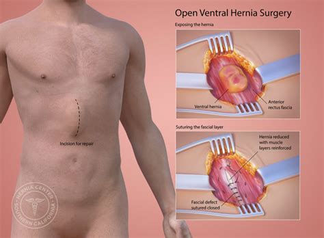 Ventral Hernia Repair Pasadena Orange County Ca