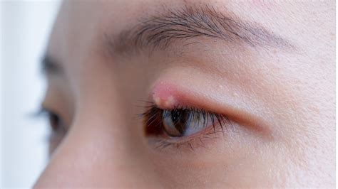 What Is A Chalazion How To Get Rid Of Eyelid Bumps GoodRx