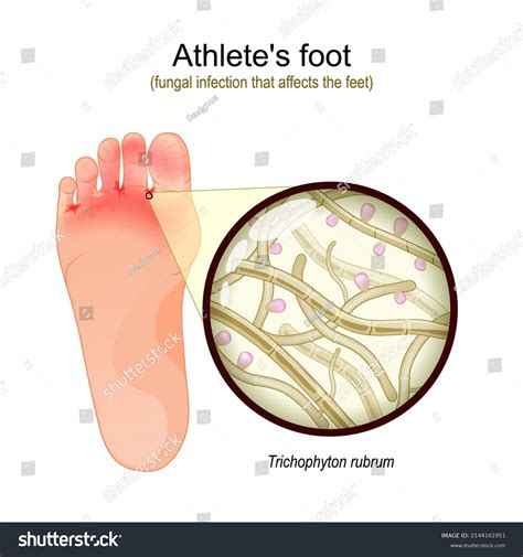 23,073 Foot infection Images, Stock Photos & Vectors | Shutterstock