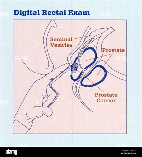 Digitale Rektale Untersuchung Fotos Und Bildmaterial In Hoher
