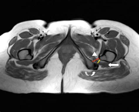 Figure 1 from Spectrum of MRI findings in ischiofemoral impingement syndrome | Semantic Scholar