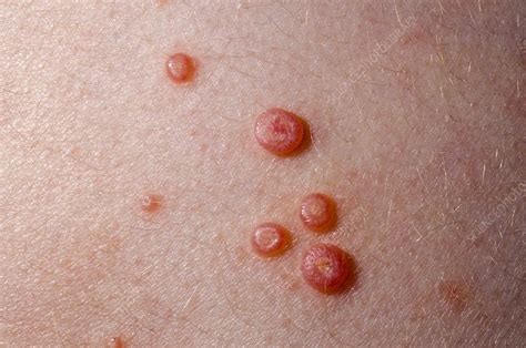 Molluscum Contagiosum Dark Skin