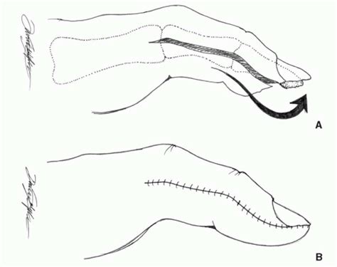 Soft Tissue Reconstruction Of The Upper Extremity Plastic Surgery Key