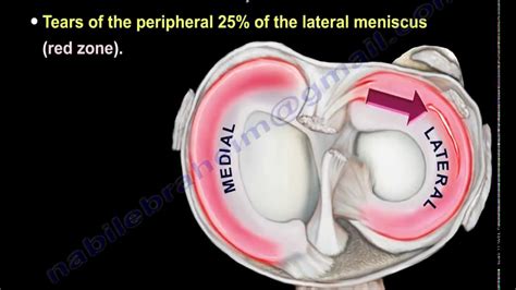 Meniscus Tear Knee Injury Lateral Meniscus Everything You Need To Know Dr Nabil Ebraheim