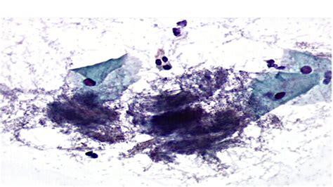 Inflamações específicas Actinomicose Microbiologia