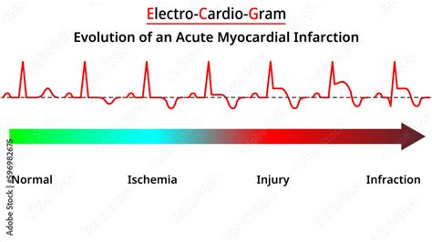 Evolution Of An Acute Myocardial Infarction Vectors And Illustrations