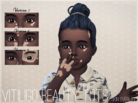 Vitiligo Skin Sims 4