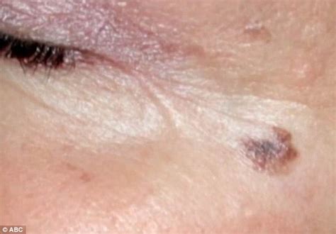 pictures of melanoma on face - pictures, photos