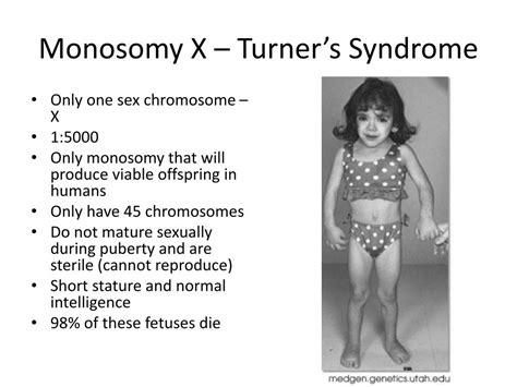 Ppt Down Syndrome Trisomy 21 Powerpoint Presentation Free Download Id2170957