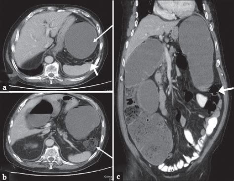 Large Bowel Obstruction In The Emergency Department Imaging Spectrum