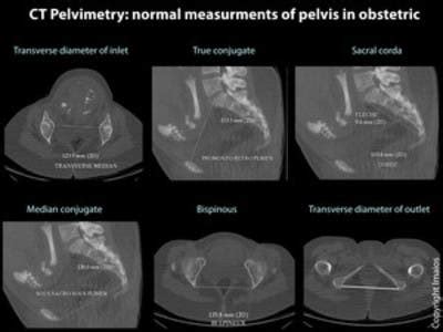 CT Pelvimetry