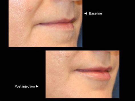 Juvederm Thin Lips Before And After | Lipstutorial.org