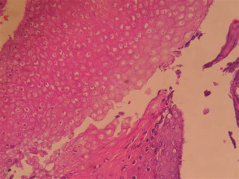 PILOMATRICOMA – Histopathology.guru