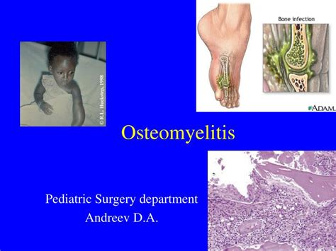 Ppt Osteomyelitis Powerpoint Presentation Free Download Id969412