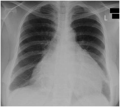 Water Bottle Sign On Chest X Ray Consistent With Pericardial Effusion