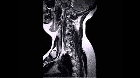 Cervical Disc Herniation MRI