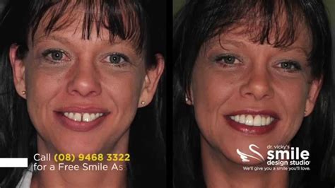 Veneers Before And After Buck Teeth