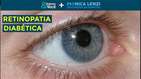 Retinopatia Diab Tica O Que Sinais E Sintomas Tratamento