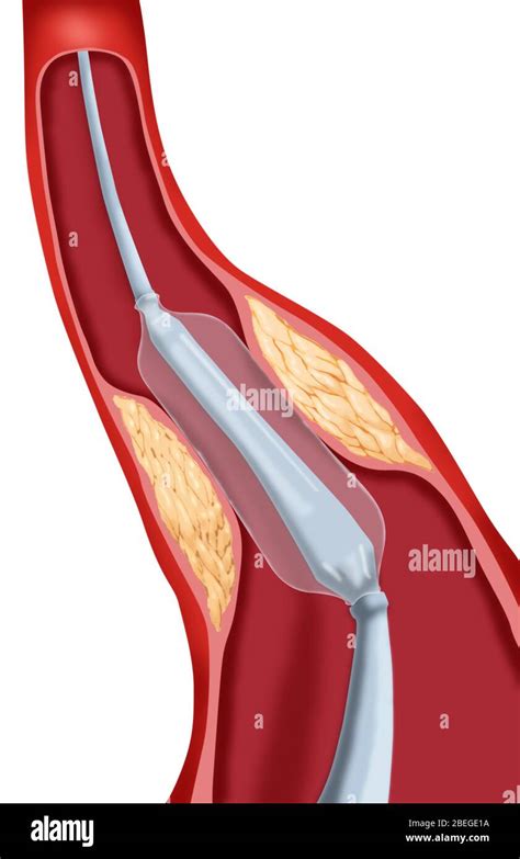 Angioplastia Con Globo Fotos E Im Genes De Stock Alamy