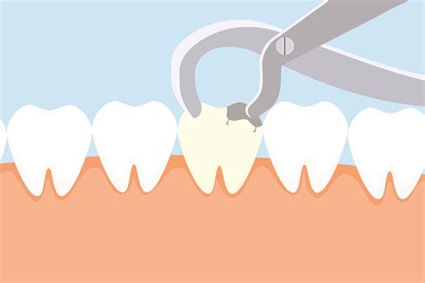 tooth extraction oshawa emergency tooth removal oshawa