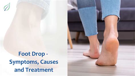 Foot Drop: Diagnosis and Treatment