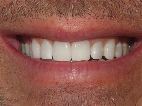 Smile Gallery | Smile Makeovers | Hinsdale Dentistry