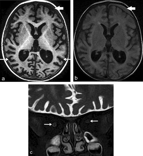 Brain MRI At Age 2 Years A Axial Volumetric T1 Weighted Image Shows