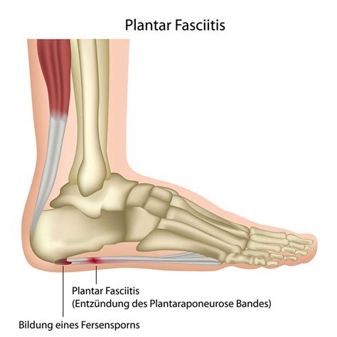 Plantar Fasciitis Treatment Ascent Health Center Chiropractor Denver Co