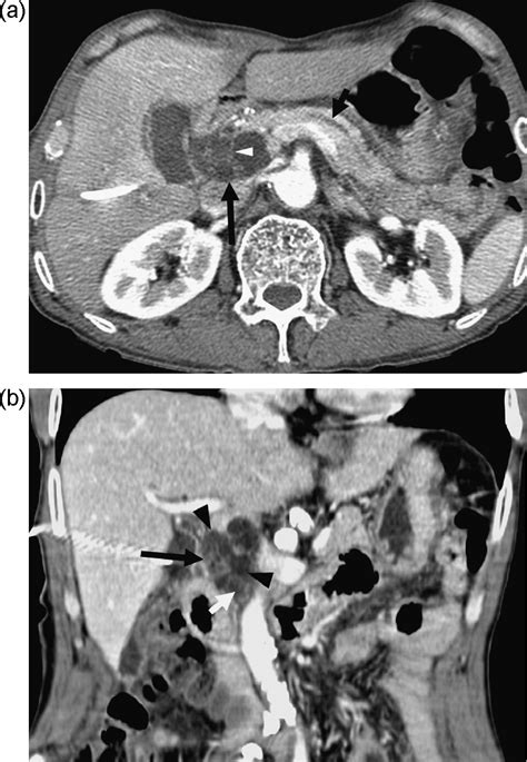 Macrocystic Pancreatic Lesions Differentiation Of Benign From