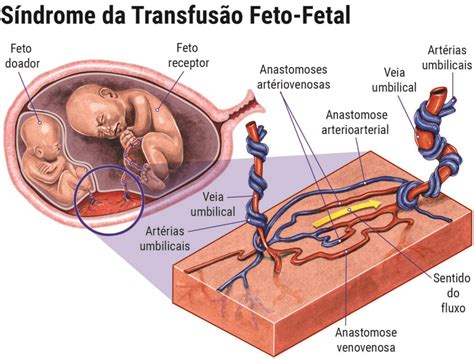 Cirurgia Fetal Fetali Medicina Fetal E Ultrassonografia