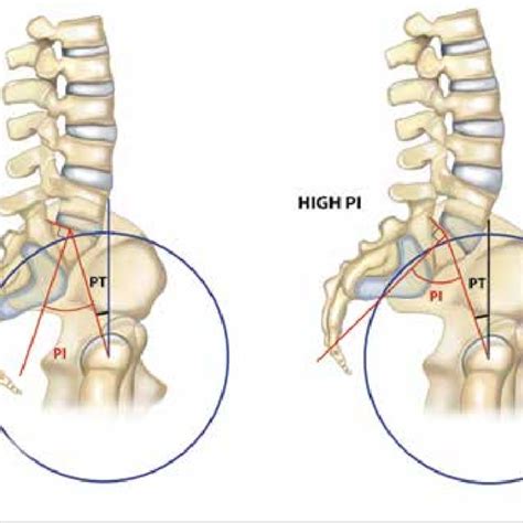 Measurement Of Sagittal Parameters By Surgimap Software Download