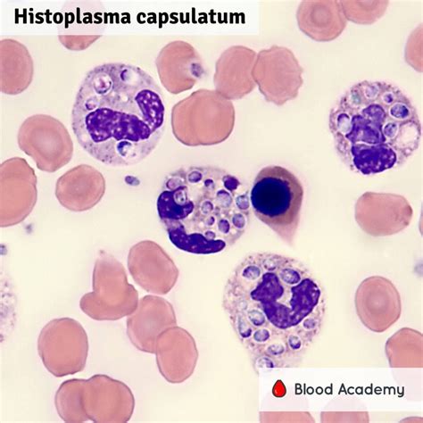 Histoplasma Capsulatum Blood Academy