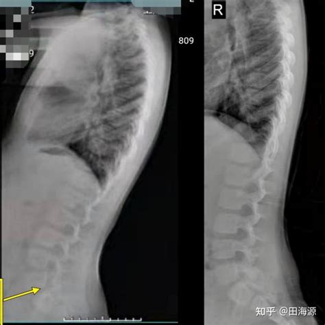 【16岁以下脊柱侧弯】康复成功案例展示 知乎