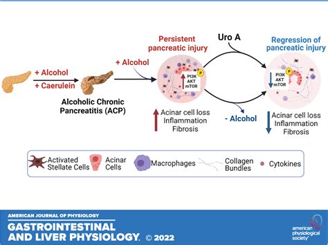 Pancreatitis Alcohol