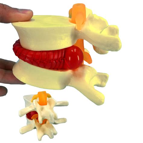 Buy Human Anatomical Lumbar Disc Herniation Model Times Life Size