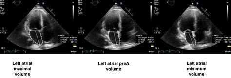 Atria A Comprehensive Evaluation With Echocardiography