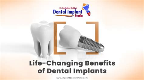 Life Changing Benefits Of Dental Implants Dental Implant Bengaluru