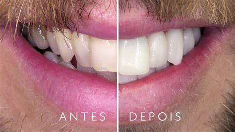 Antes E Depois Implante Dent Rio Protocolo Total Youtube