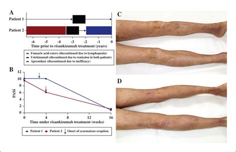 Jle European Journal Of Dermatology Eczematous Eruption In Patients With Psoriasis During