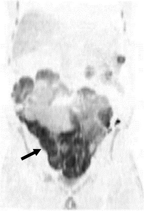 Whole Body Mri Current Applications In Oncology Ajr