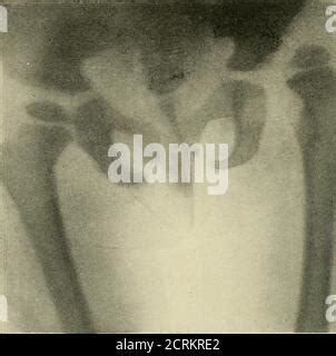 X Ray Congenital Dislocation Of Hips Stock Photo Alamy