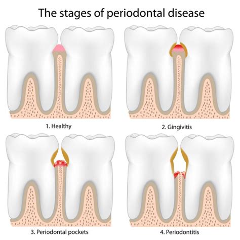 Signs Symptoms Of Periodontal Disease Parker Periodontics And