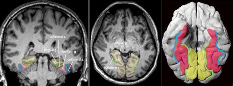 Lingual Gyrus Lingual Gyrus An Overview Sciencedirect Topics