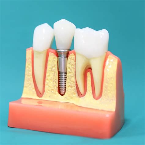 Check Out Our 7 Tips For Optimal Aftercare Of Dental Implants Sun