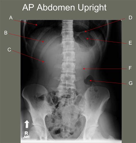 AP Abdomen Upright Diagram Quizlet