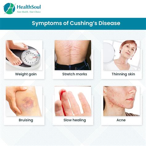 Top Pictures Cushing S Syndrome Cushing S Disease Before And After